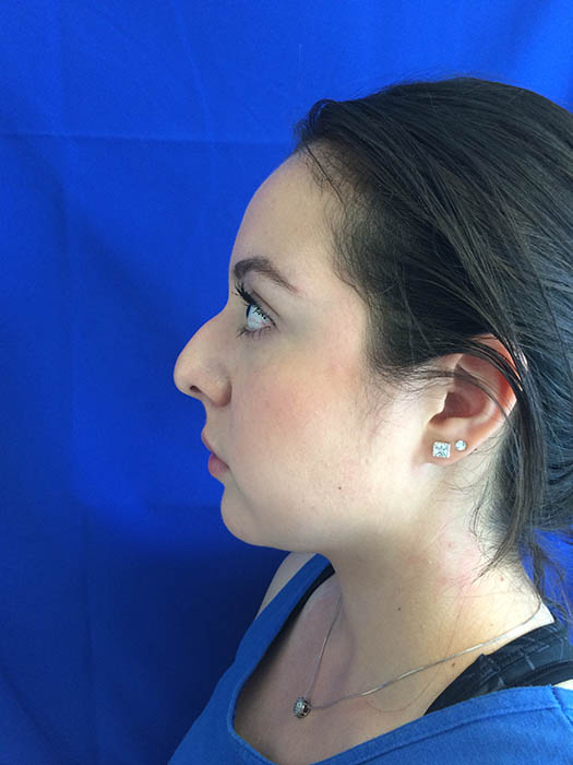 Rhinoplasty Before & After Image