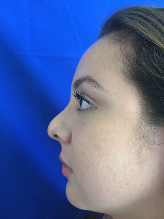 Rhinoplasty Before & After Image