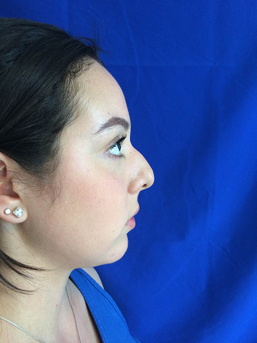 Rhinoplasty Before & After Image