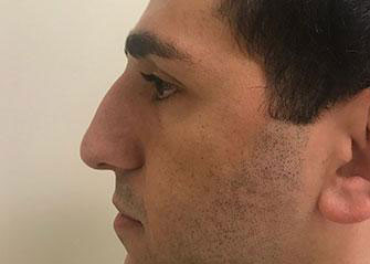 Rhinoplasty Before & After Image