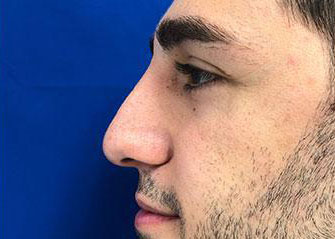 Rhinoplasty Before & After Image