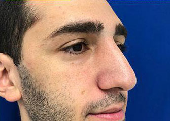 Rhinoplasty Before & After Image