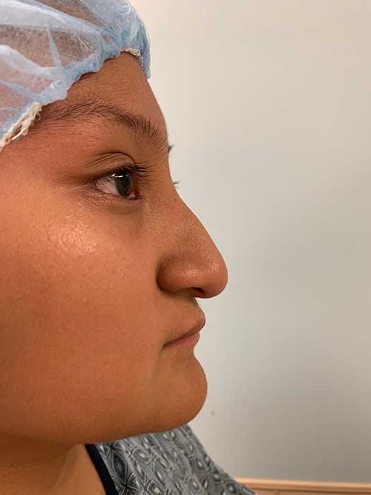 Rhinoplasty Before & After Image