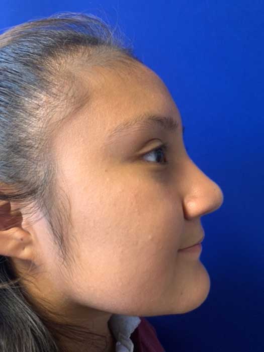 Rhinoplasty Before & After Image