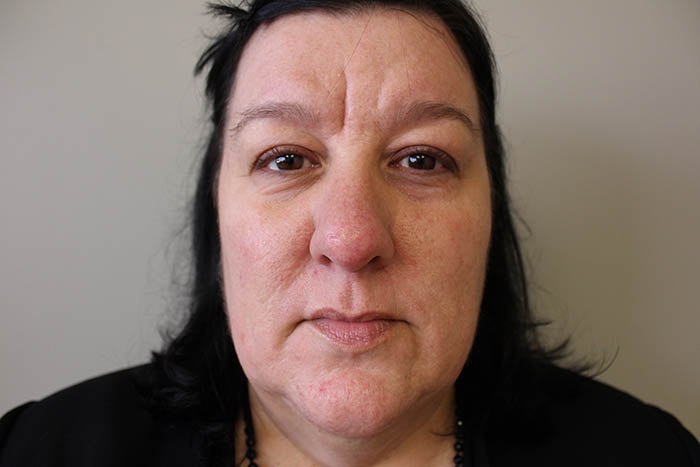 Dermal Filler Before & After Image