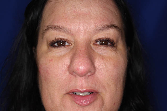 Dermal Filler Before & After Image