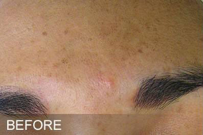 Hydrafacial Before & After Image