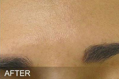 Hydrafacial Before & After Image