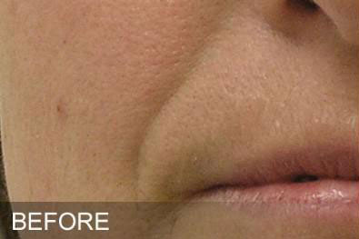 Hydrafacial Before & After Image