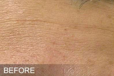 Hydrafacial Before & After Image