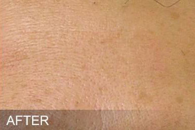 Hydrafacial Before & After Image