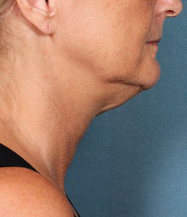 Kybella Before & After Image