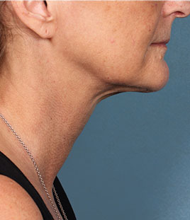 Kybella Before & After Image