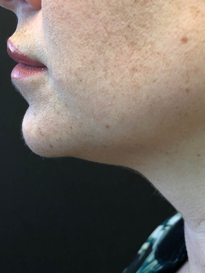 Kybella Before & After Image