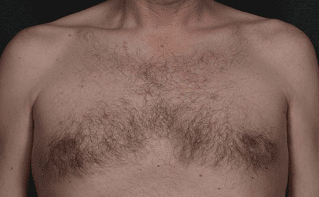 Laser Hair Removal Before & After Image