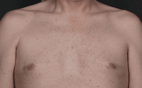 Laser Hair Removal Before & After Image