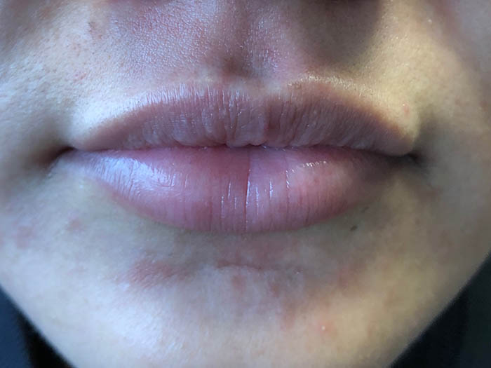 Lip Filler Before & After Image