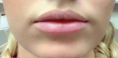 Lip Filler Before & After Image