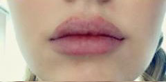 Lip Filler Before & After Image