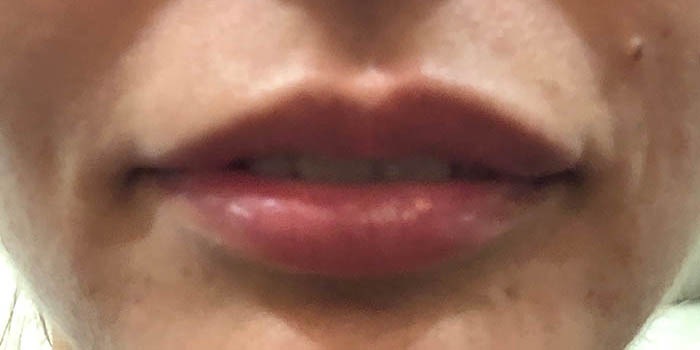 Lip Filler Before & After Image