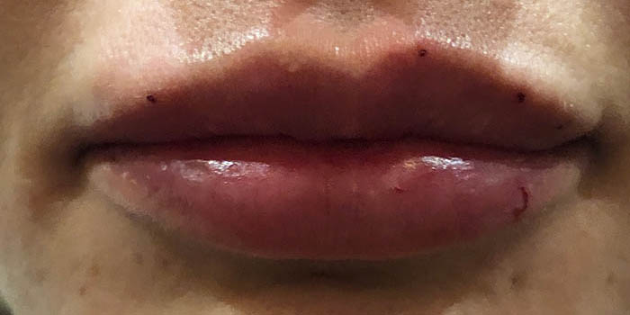 Lip Filler Before & After Image