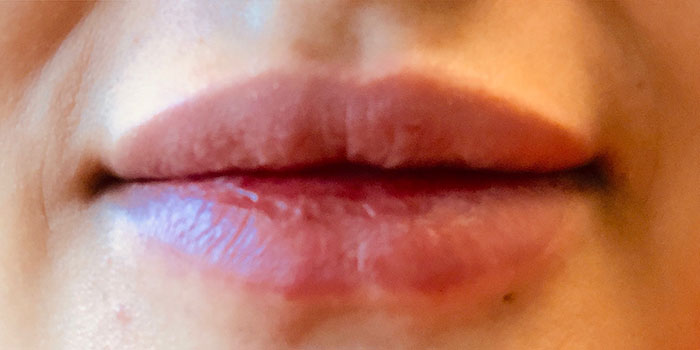 Lip Filler Before & After Image