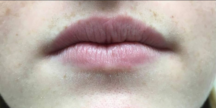 Lip Filler Before & After Image