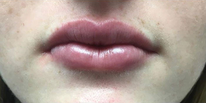 Lip Filler Before & After Image