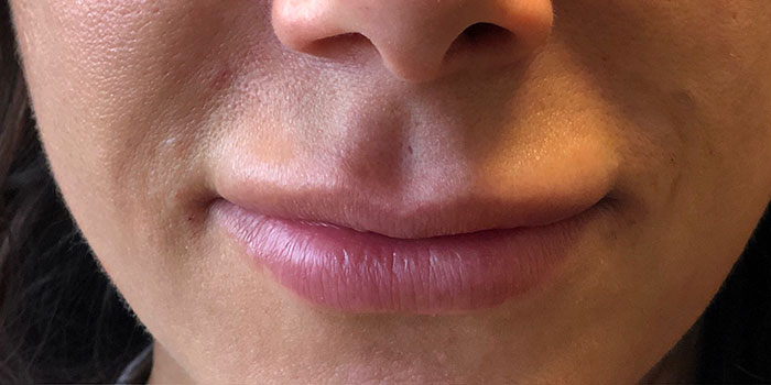 Lip Filler Before & After Image