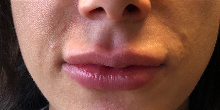 Lip Filler Before & After Image