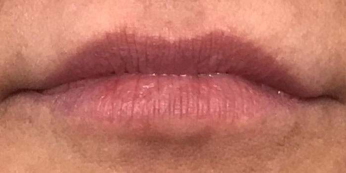 Lip Filler Before & After Image