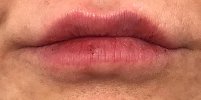 Lip Filler Before & After Image