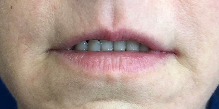 Lip Filler Before & After Image