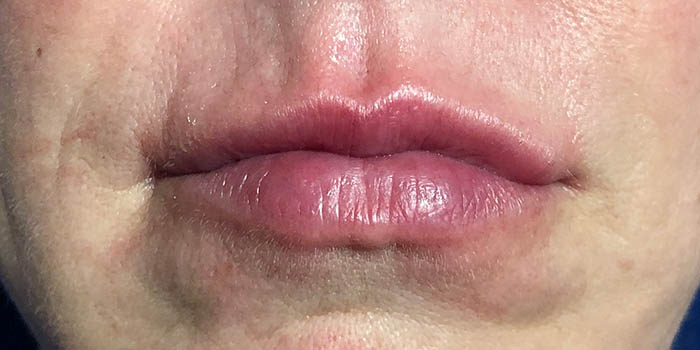 Lip Filler Before & After Image