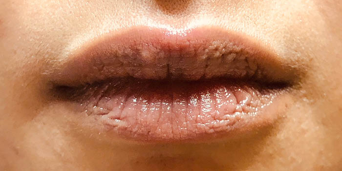 Lip Filler Before & After Image