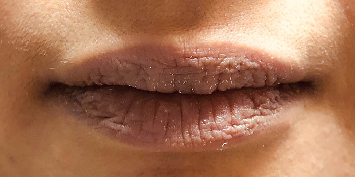 Lip Filler Before & After Image