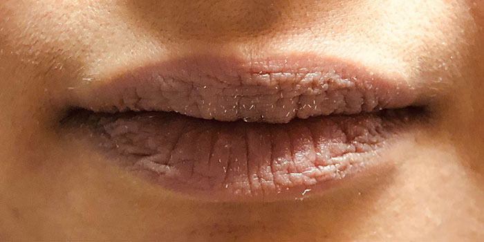 Lip Filler Before & After Image