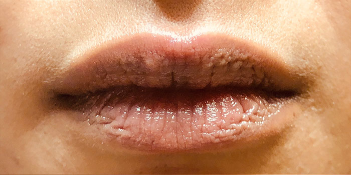 Lip Filler Before & After Image