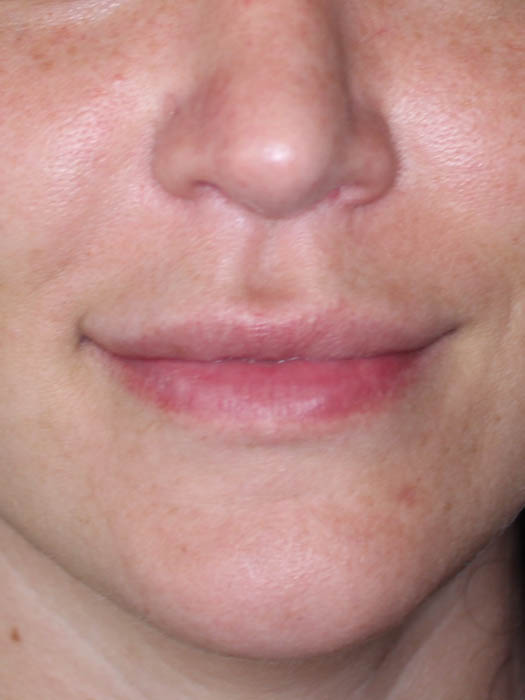 Lip Filler Before & After Image