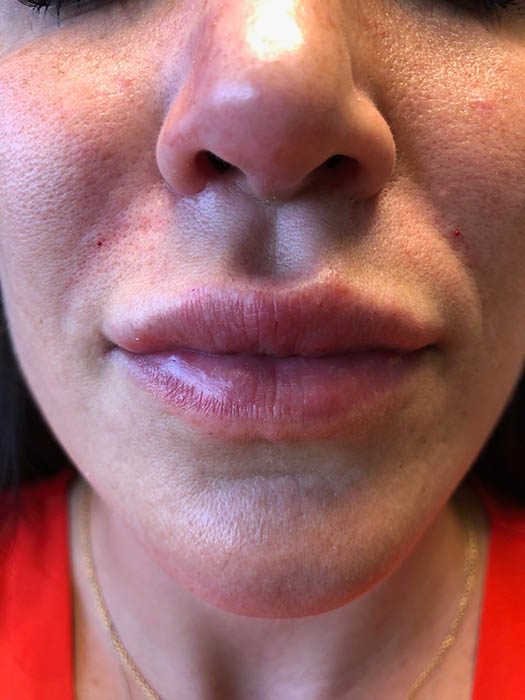 Lip Filler Before & After Image