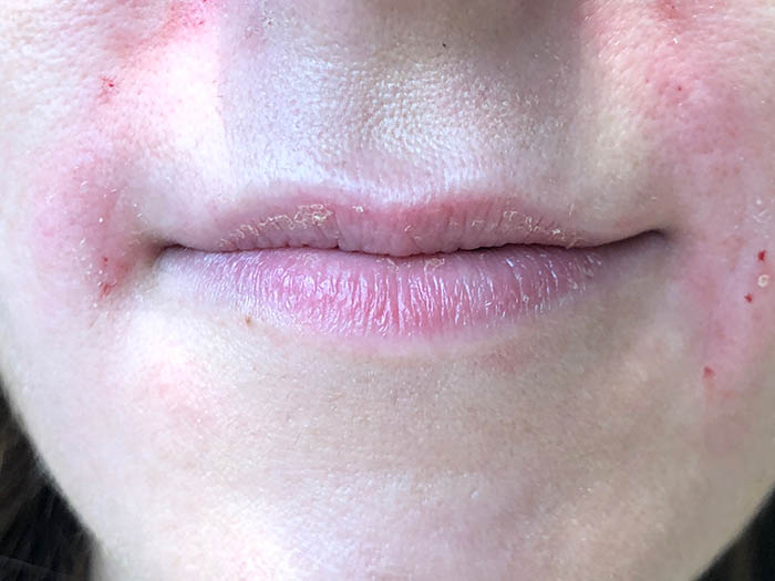 Lip Filler Before & After Image