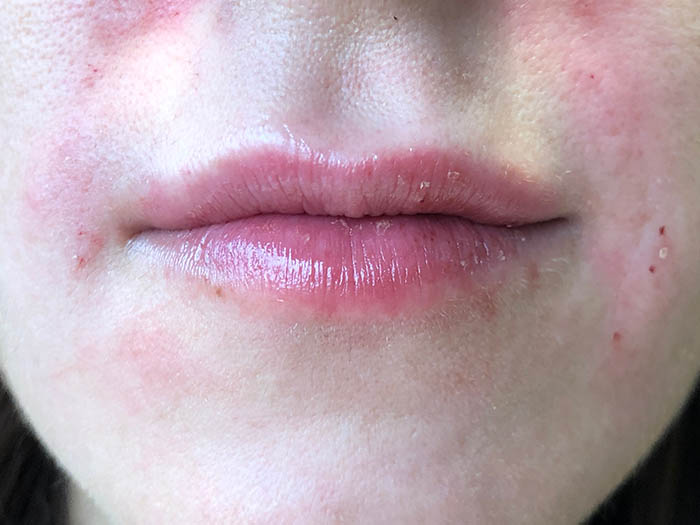 Lip Filler Before & After Image