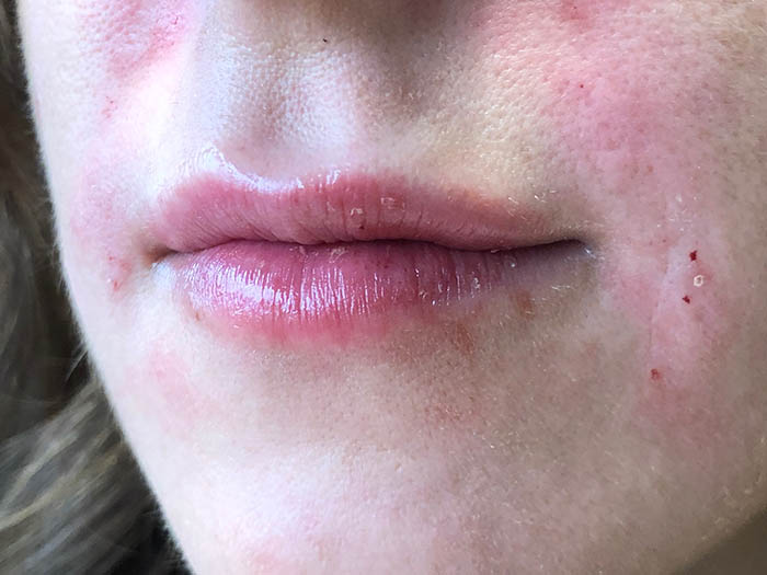 Lip Filler Before & After Image