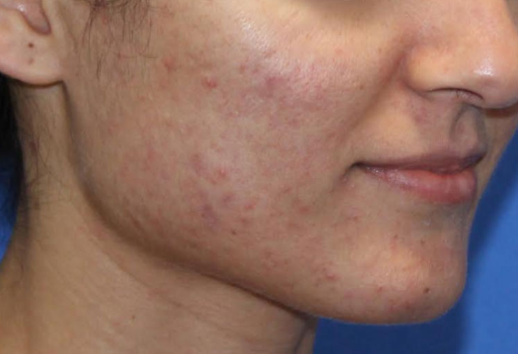 Microneedling Before & After Image