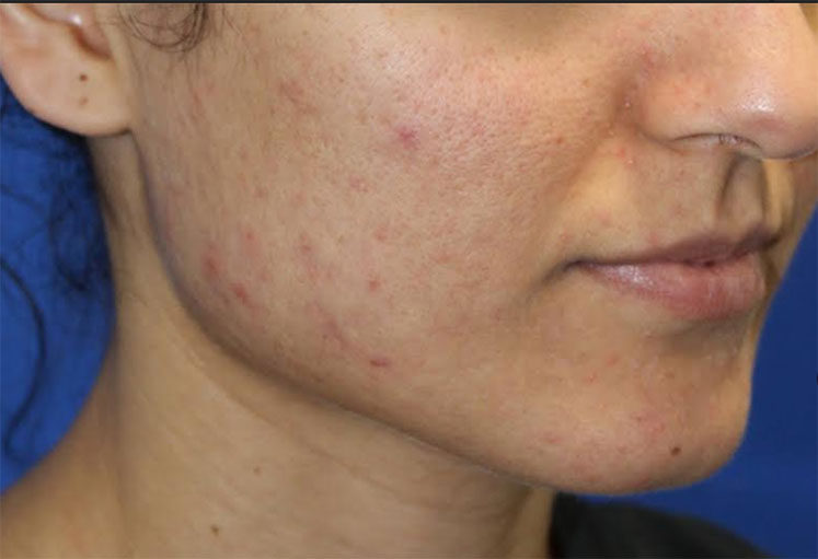 Microneedling Before & After Image