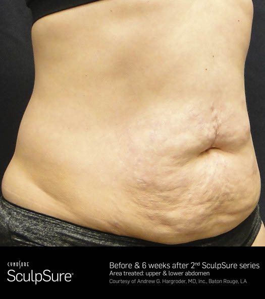 Sculpsure Before & After Image