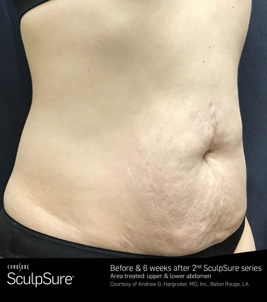 Sculpsure Before & After Image