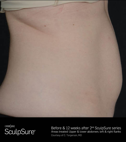 Sculpsure Before & After Image