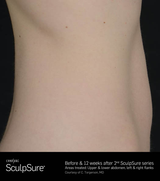 Sculpsure Before & After Image