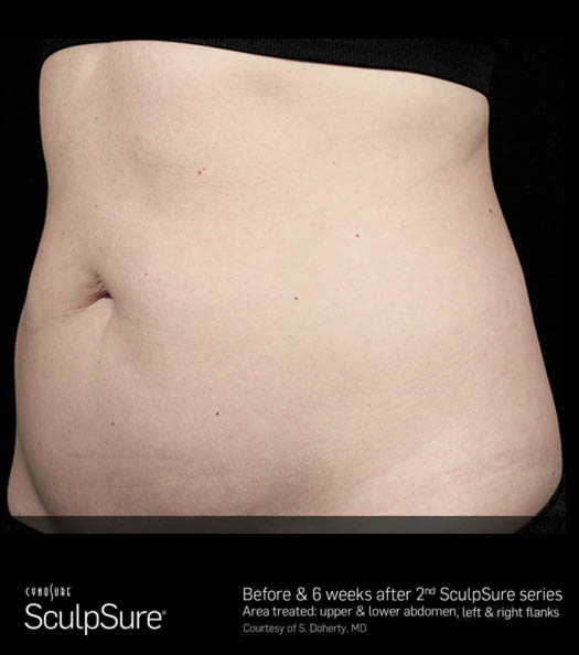 Sculpsure Before & After Image